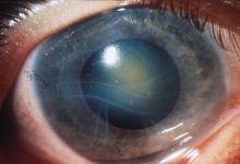 Фото - Офтальмолог Пронкин рассказал, кому грозят катаракта и глаукома