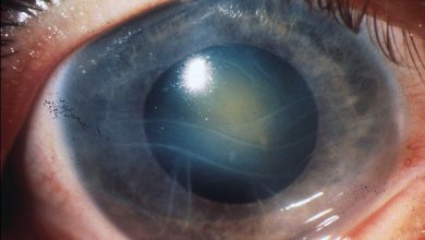 Фото - Офтальмолог Пронкин рассказал, кому грозят катаракта и глаукома